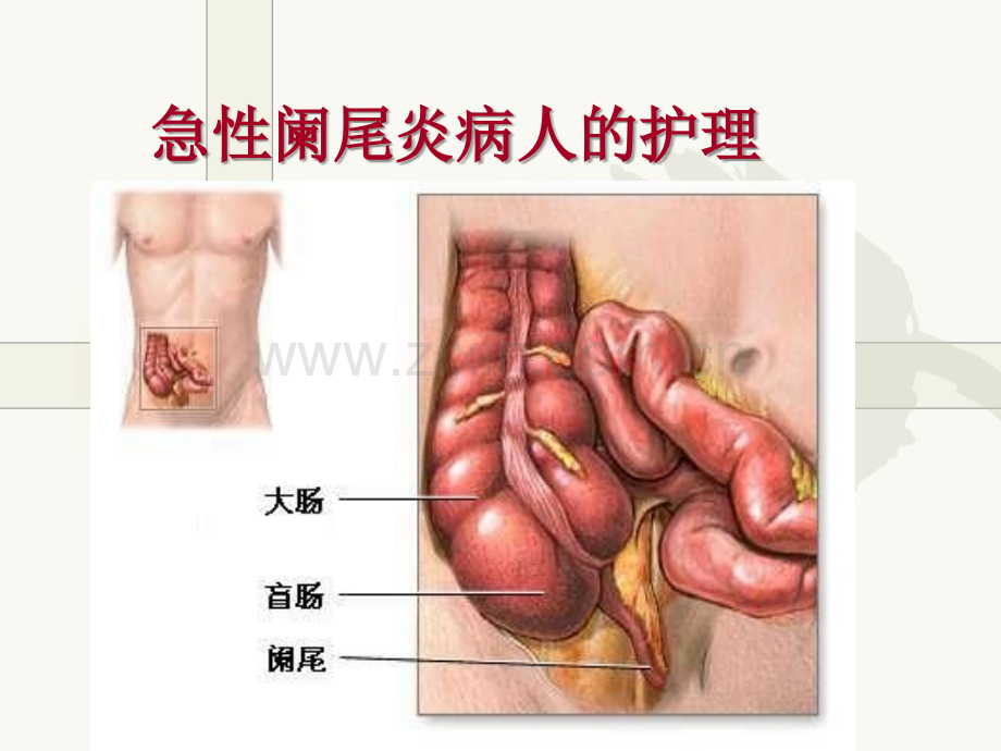 急性阑尾炎病人的护理(2).ppt_第1页