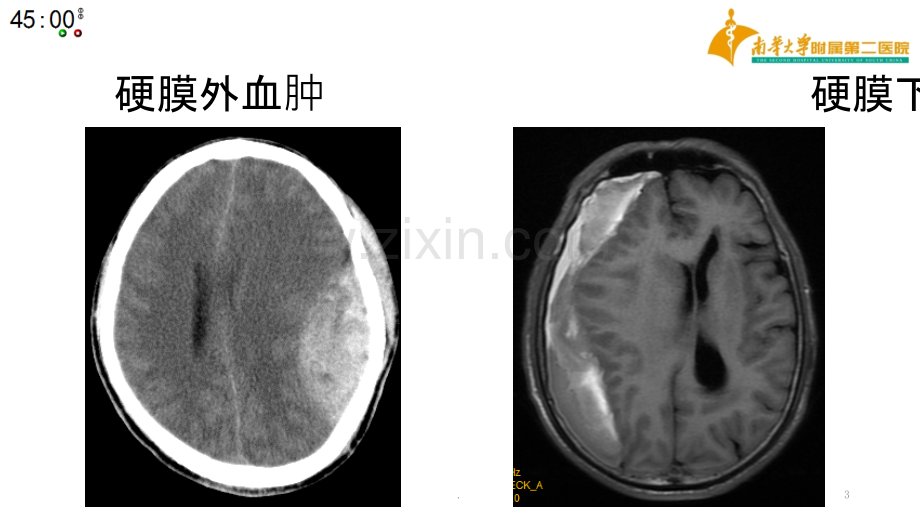 基层神经外科常见引流管介绍.ppt_第3页