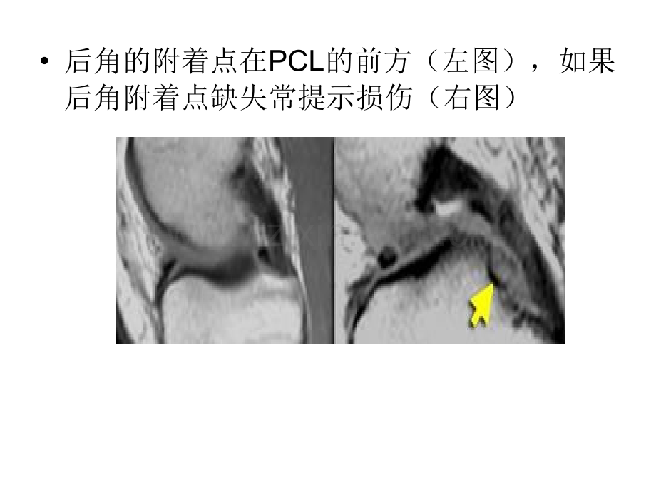 半月板的影像学表现分析演示课件.ppt_第3页