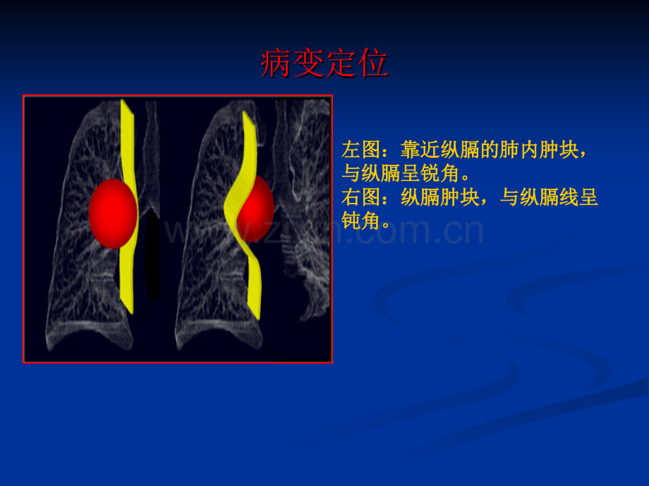 纵膈原发性肿瘤.ppt_第2页