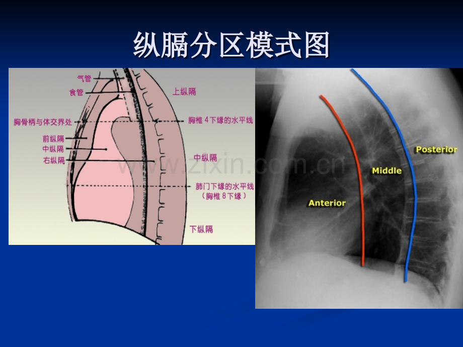 纵膈原发性肿瘤.ppt_第3页