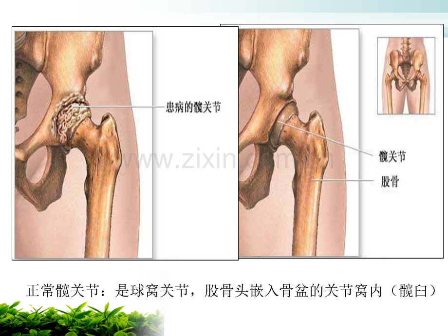 人工髋关节置换术后的护理进展.ppt_第3页