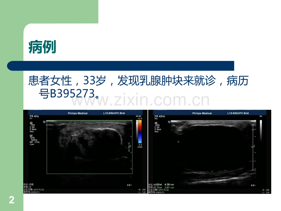 积乳囊肿.ppt_第2页