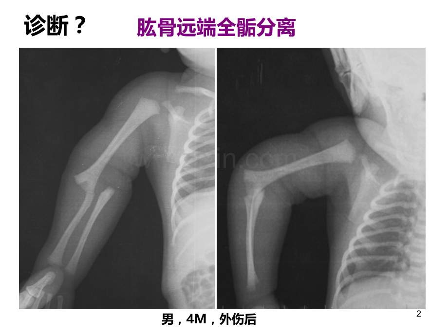 儿童骨骺损伤影像诊断(急).ppt_第2页