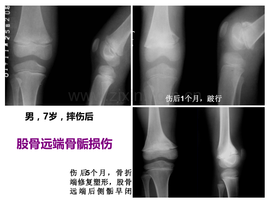 儿童骨骺损伤影像诊断(急).ppt_第3页