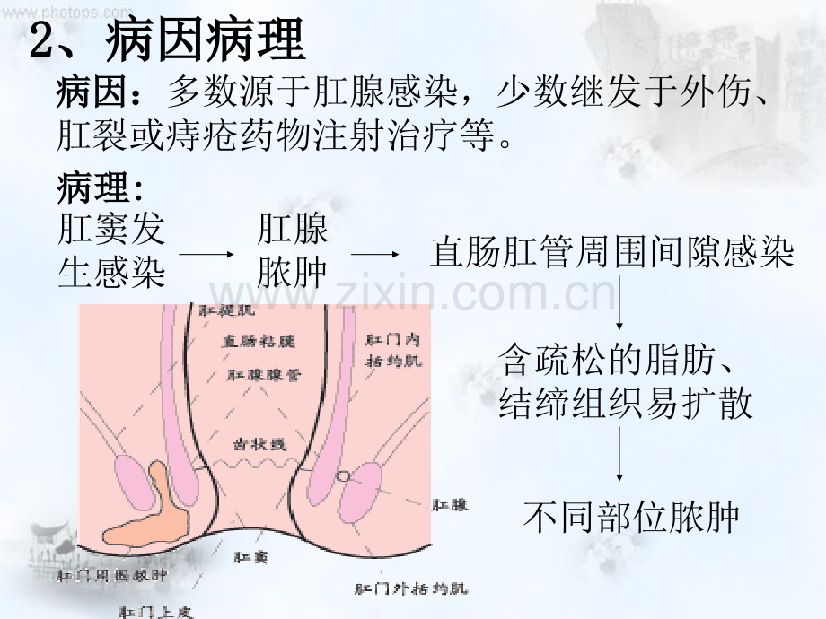 肛周脓肿护理查房.ppt_第3页