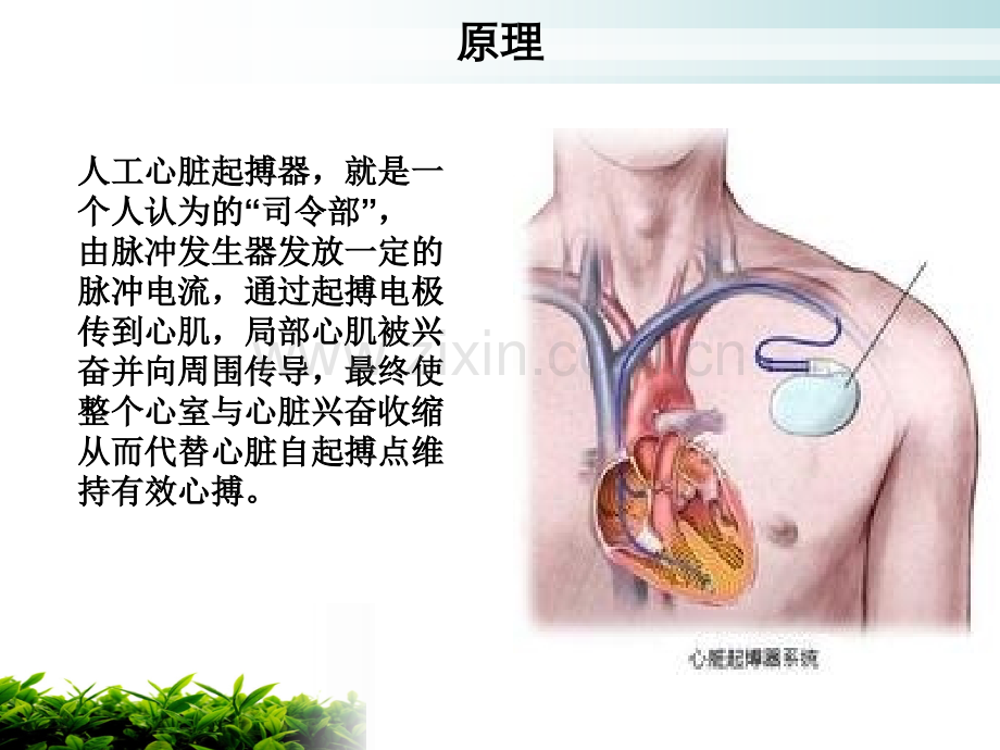 起搏器植入术的健康教育.ppt_第3页