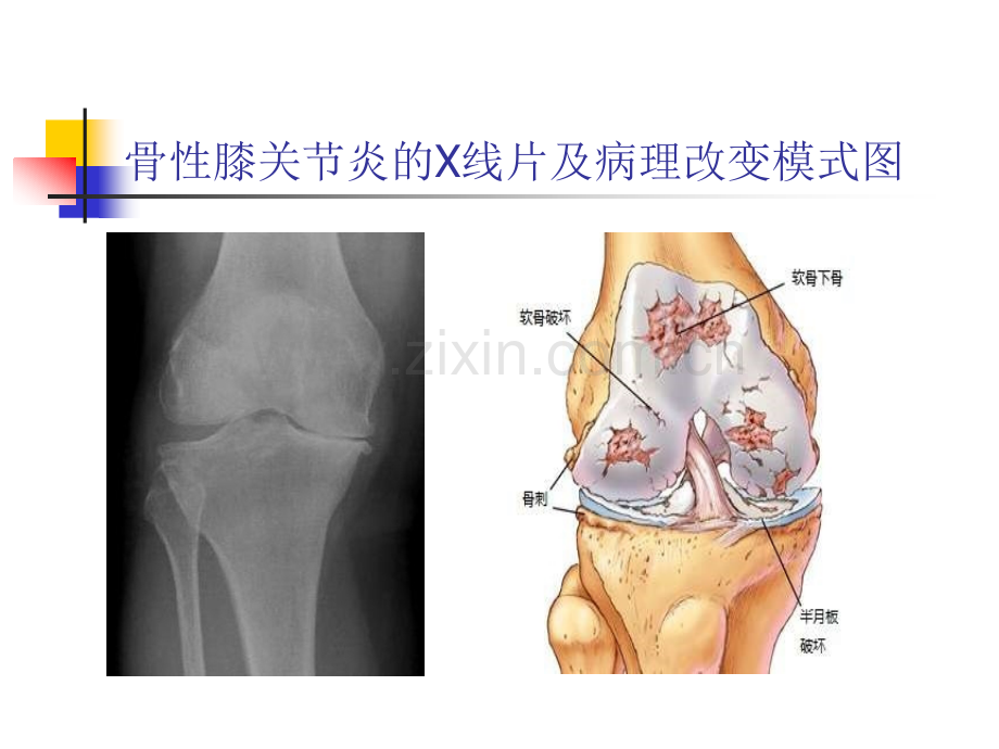 热敏灸治疗骨性膝关节炎.ppt_第3页