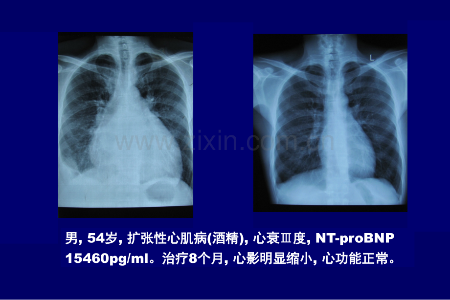 慢性收缩性心力衰竭.ppt_第2页