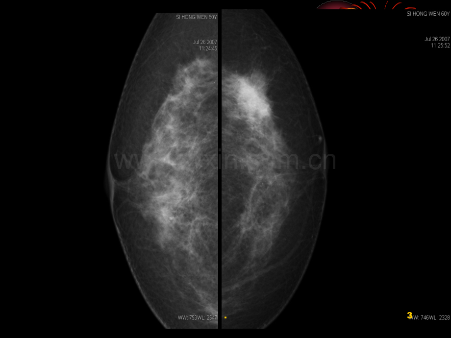 乳腺钼靶精美课件.ppt_第3页