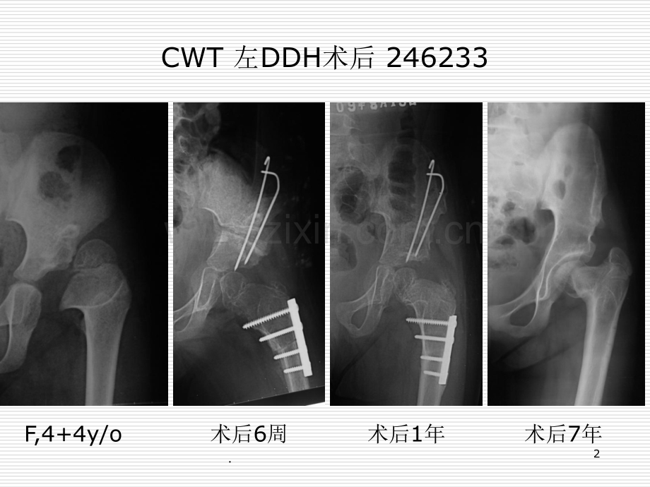 儿童股骨近端畸形评估与矫正策略.ppt_第2页