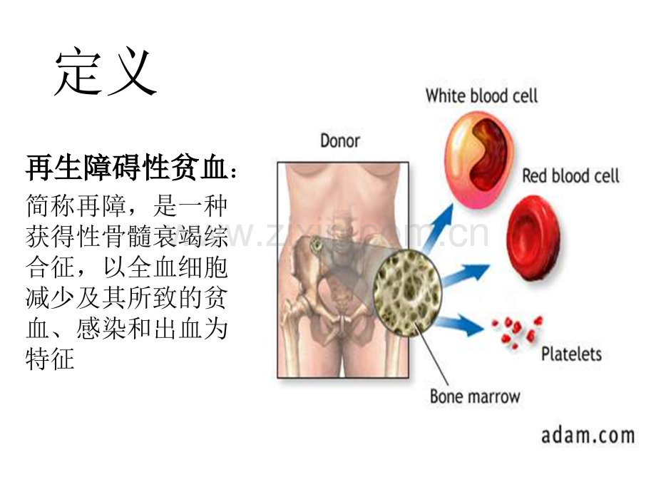 再生障碍性贫血.ppt_第2页