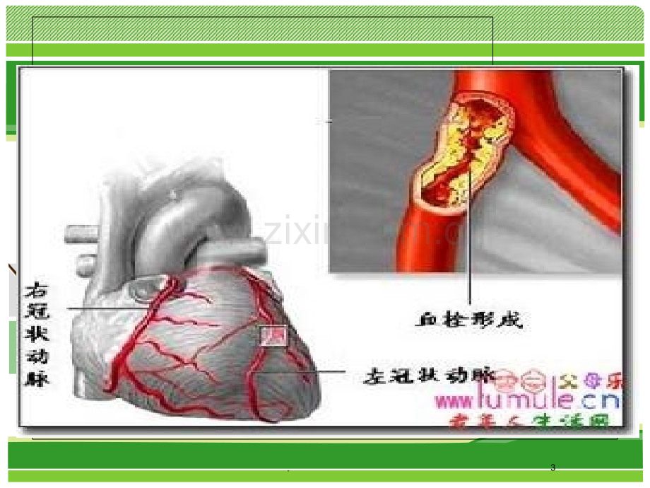 急性心肌梗死患者护理查房.ppt_第3页