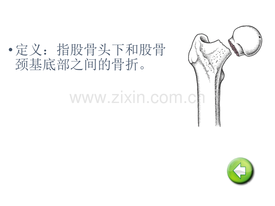 护理股骨颈骨折病人的护理课件.ppt_第3页