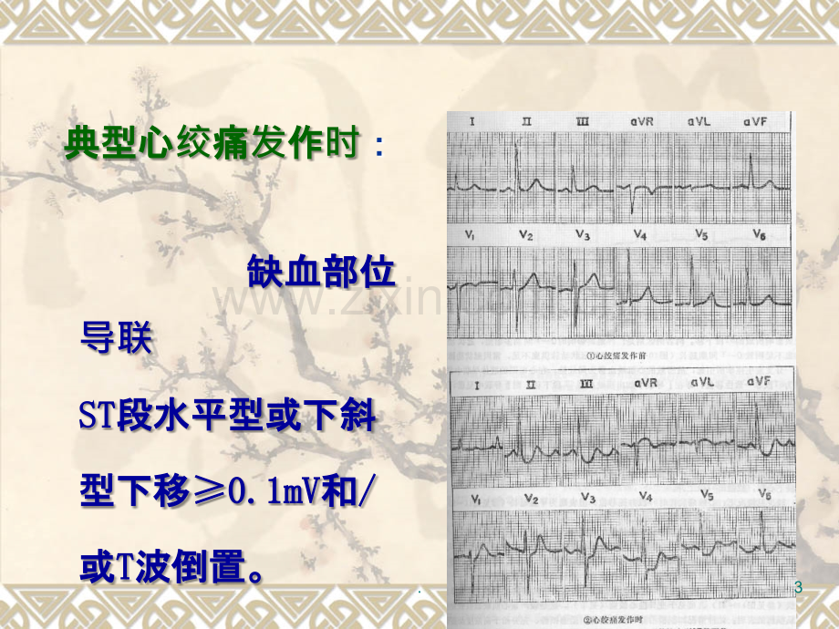 心肌缺血心电图.ppt_第3页