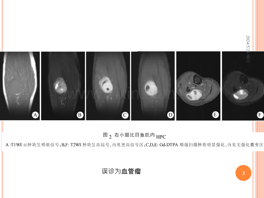 颅内血管外皮细胞瘤的影像学表现.ppt_第3页