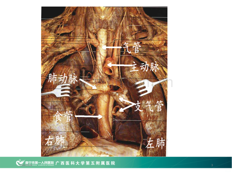 食管平滑肌瘤--张迎春.ppt_第3页