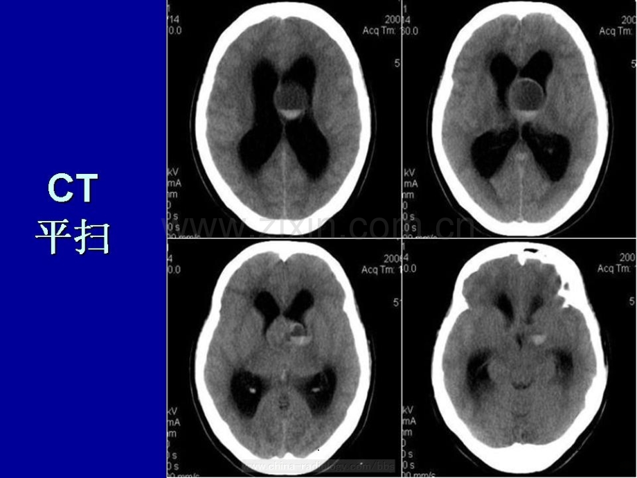 血管肌纤维母细胞瘤.ppt_第2页