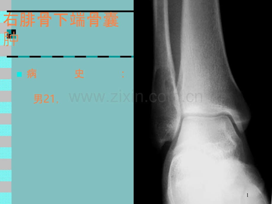 骨肿瘤X线病例图谱.ppt_第1页