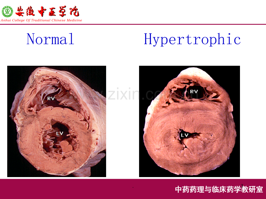 抗慢性心功能不全药抗心力衰竭药.ppt_第3页