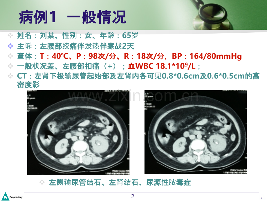 泌尿系统结石抗感染治疗策略.ppt_第2页