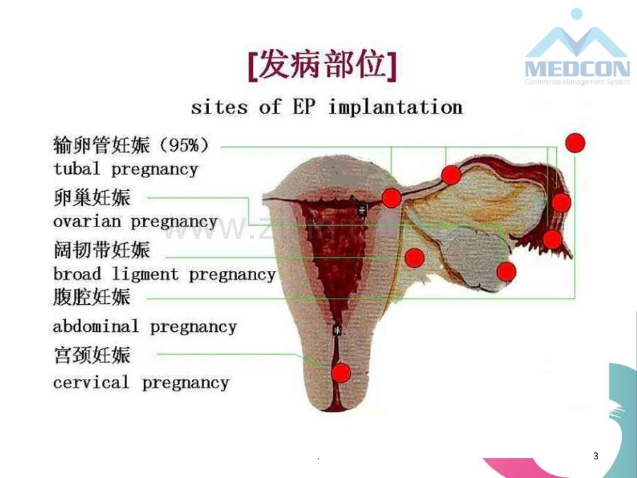 特殊部位异位妊娠的介入治疗.ppt_第3页