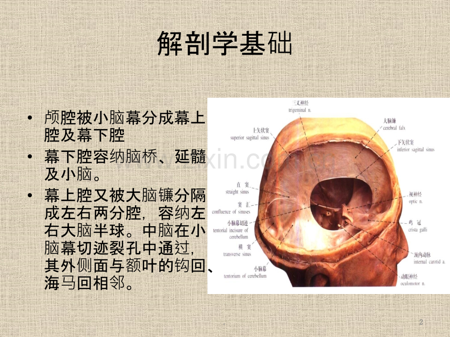 脑疝影像表现.ppt_第2页