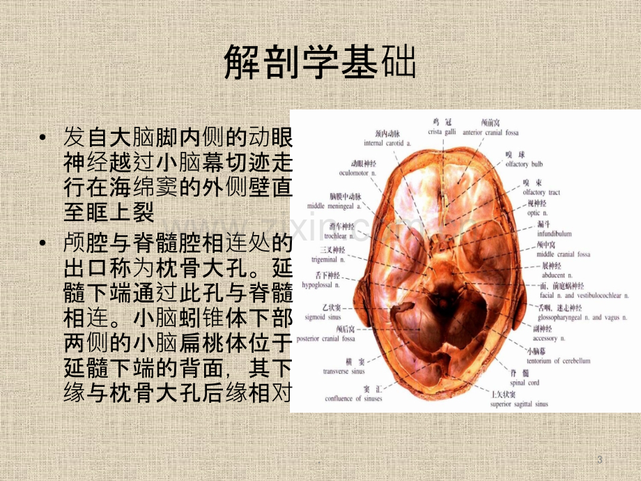 脑疝影像表现.ppt_第3页