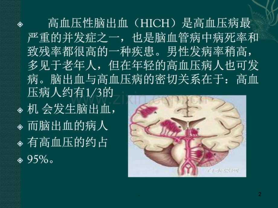 高血压性脑出血的手术治疗ppt课件.ppt_第2页