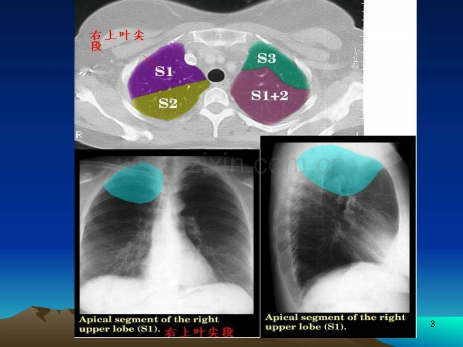 胸部基本病变及常见征象(1)ppt课件.ppt_第3页