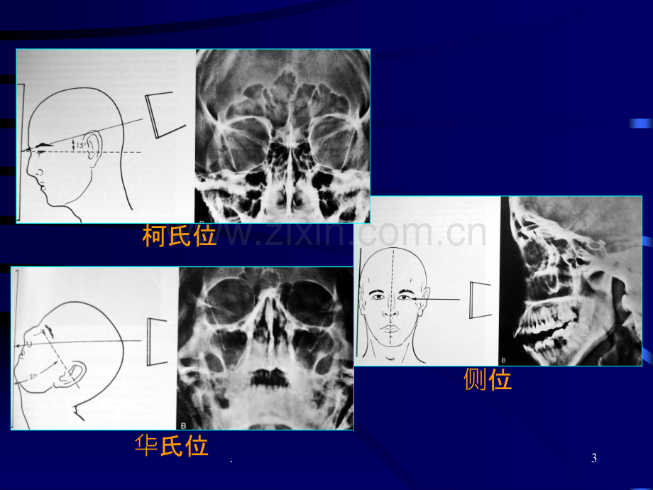 鼻、鼻窦影像学表现课件.ppt_第3页