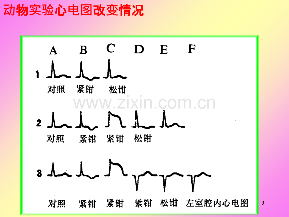 急性心肌梗死心电图演变.ppt_第3页