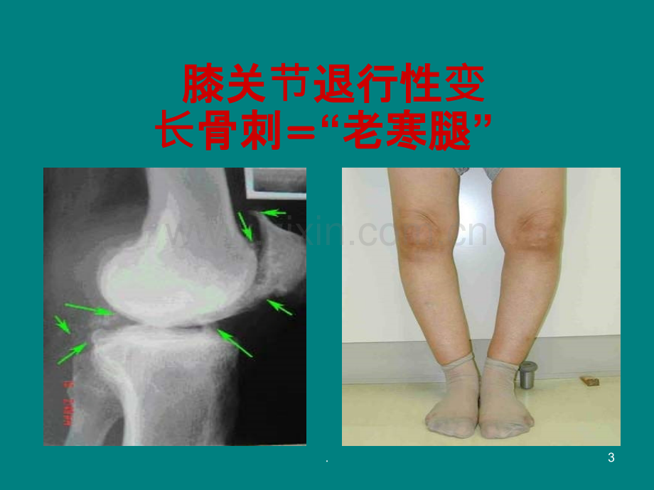 健康知识讲座膝关节ppt课件.ppt_第3页