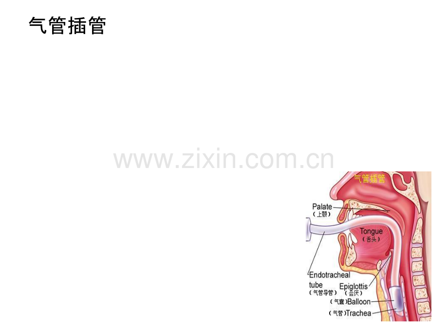 气管插管和气道湿化.ppt_第3页