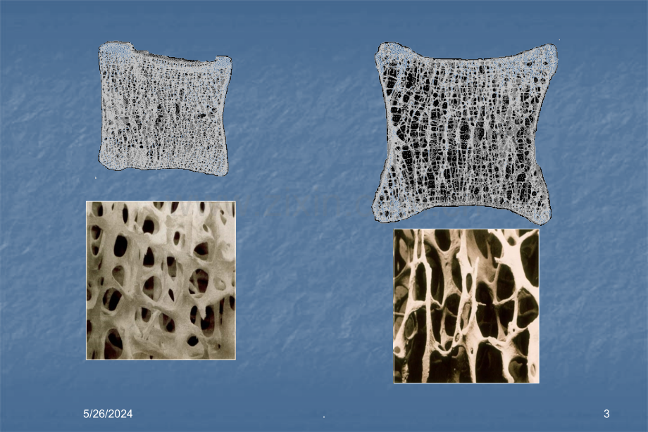 骨质疏松症ppt课件.ppt_第3页