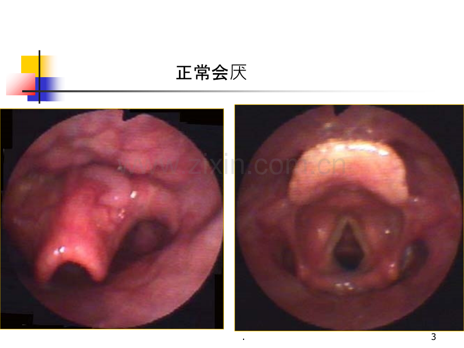 急性会厌炎课件.ppt_第3页