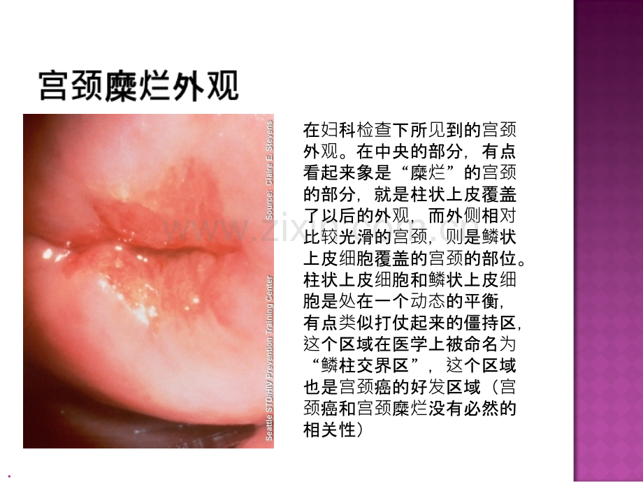 宫颈疾病.ppt_第3页