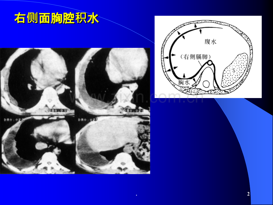 诊断课件胸腹水.ppt_第2页