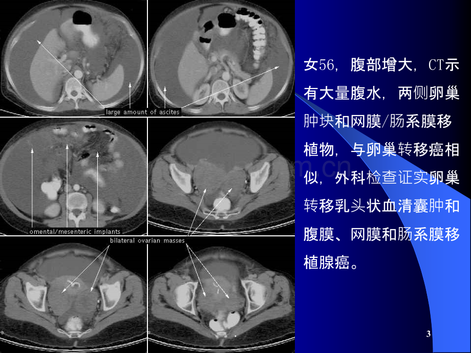 诊断课件胸腹水.ppt_第3页