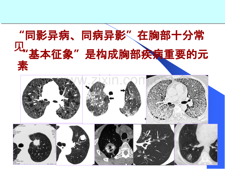 肺部CT征象.ppt_第2页