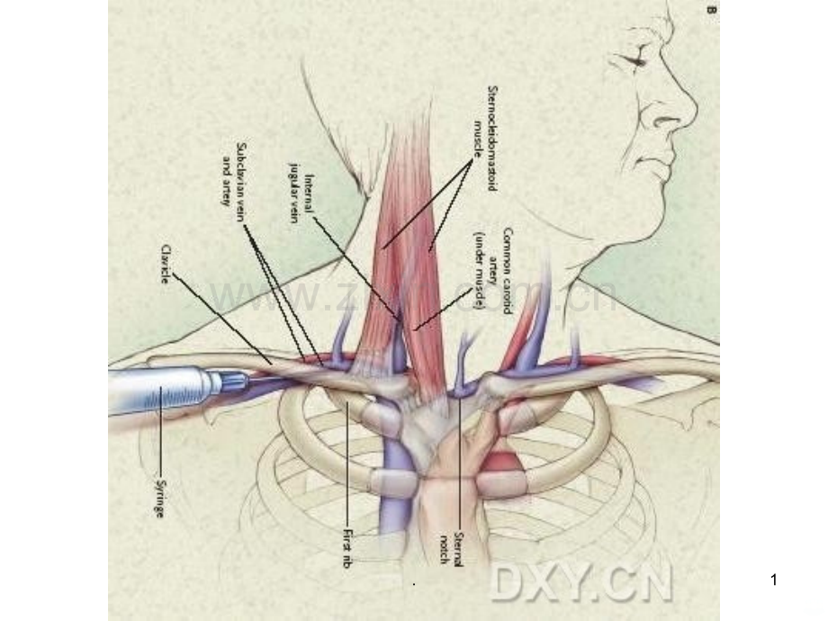 锁骨下静脉穿刺图示.ppt_第1页