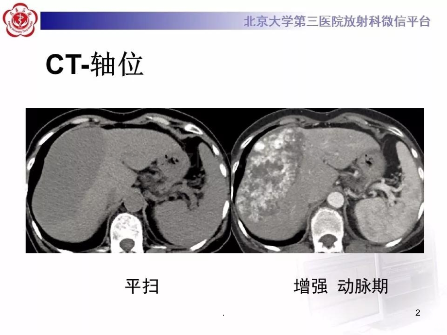 肝血管肉瘤.ppt_第2页