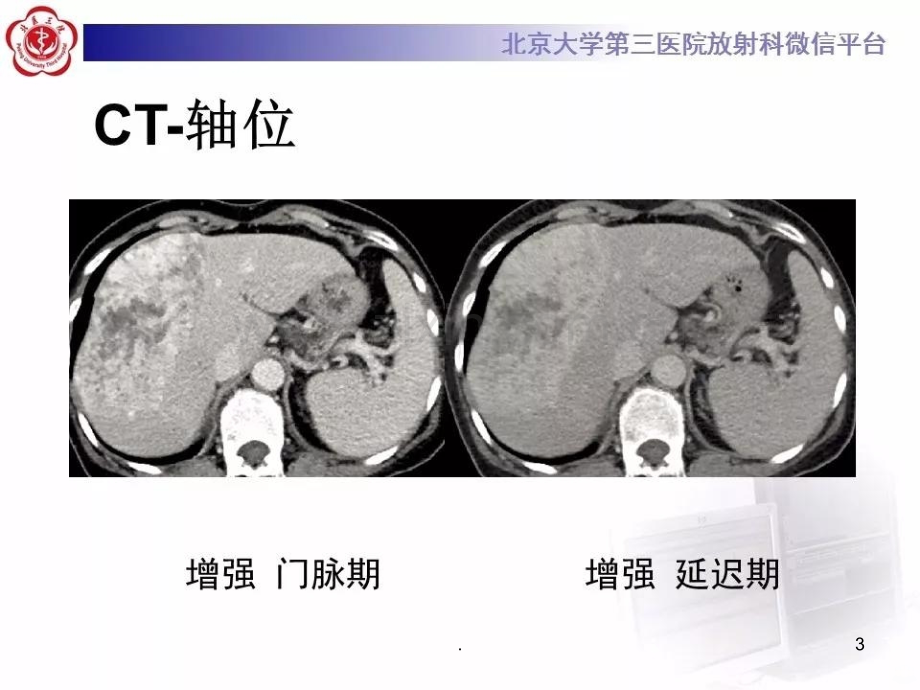 肝血管肉瘤.ppt_第3页