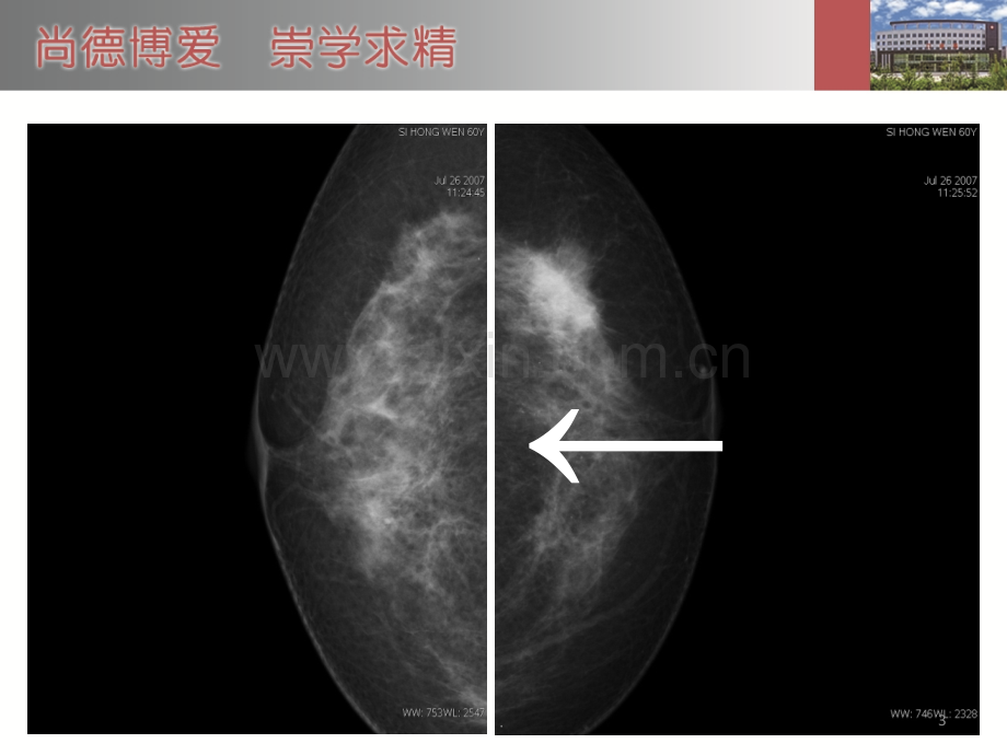 乳腺钼靶课件--兰永刚ppt课件.ppt_第3页