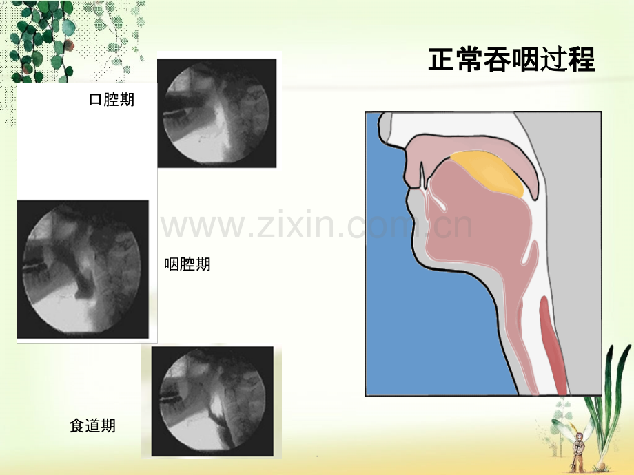 吞咽障碍的临床治疗-总结.ppt_第3页