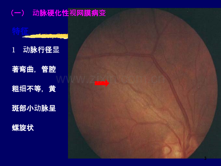 全身疾病的眼部表现课件.ppt_第3页