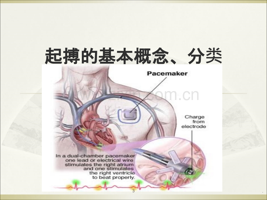 心律失常的起搏治疗ppt课件.ppt_第3页