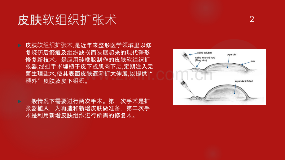 扩张器并发症.ppt_第2页