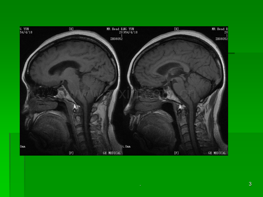 四脑室肿瘤ppt课件.ppt_第3页