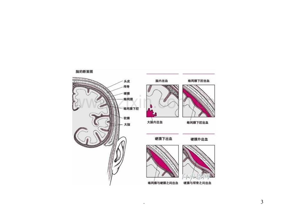 蛛网膜下腔出血(1)ppt课件.ppt_第3页